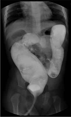 Effect of megarectum on postoperative defecation of female patients with congenital rectovestibular fistula or rectoperineal fistula